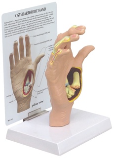 Osteoartróza - model ruky