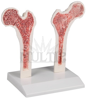 Osteoporóza stehenní kosti