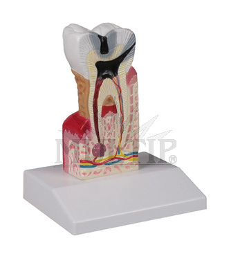 Model zubního kazu-10x zvětšený