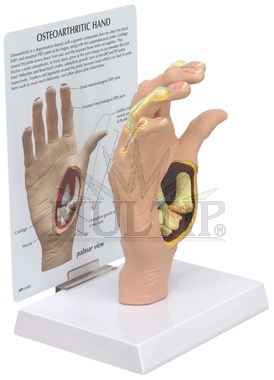 Osteoartróza - model ruky